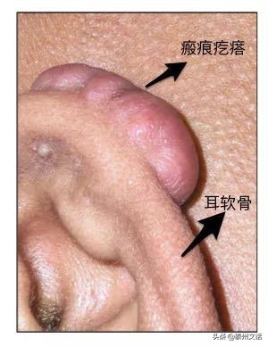 打耳洞后要知道的知识,打耳洞容易出事情吗