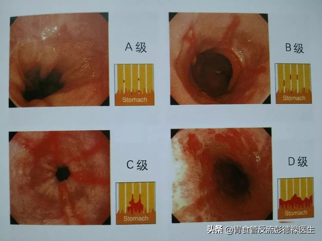 32岁男子反酸烧心,反流性食管炎吞咽疼痛有多疼