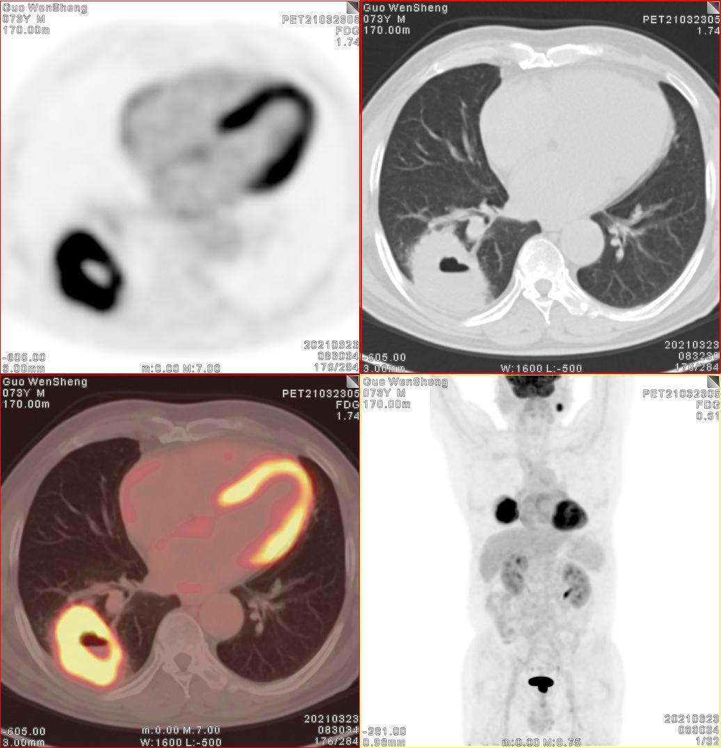 肺癌双肺弥漫转移生存期,肺结节小但是骨转移