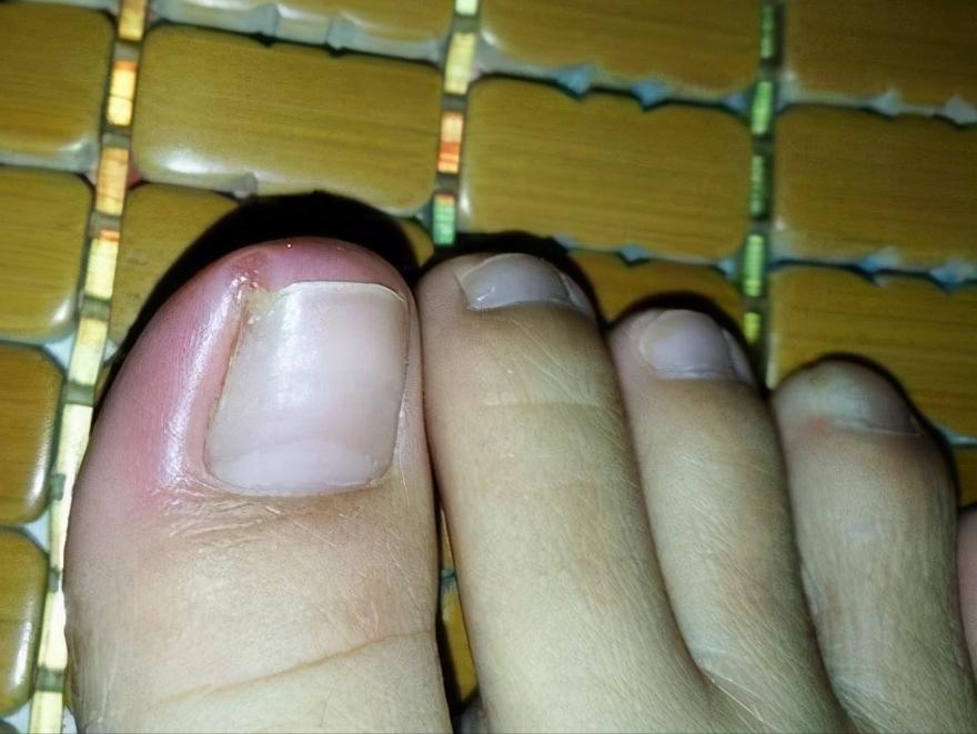 湖北20岁小伙感冒发烧,25岁小伙突然偏瘫