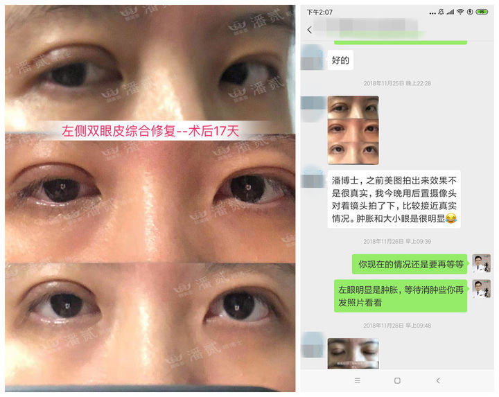 双眼皮手术后问题,双眼皮术后怎么才知道恢复好了没