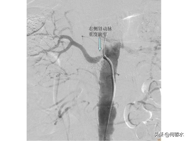 颈动脉狭窄介入治疗,颈动脉狭窄介入手术多少钱