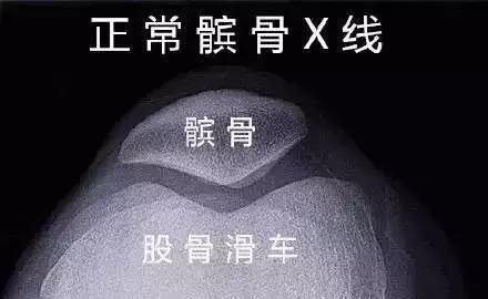 髌骨脱位了怎么办？！康复练习法有哪些（图文解说）