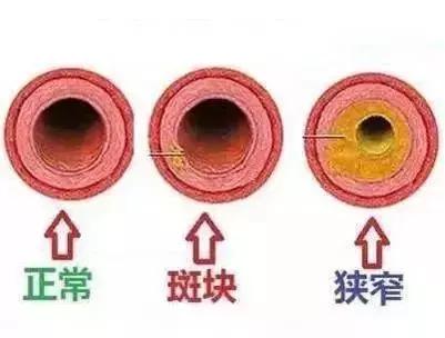 颈动脉有斑块怎么预防中风,双侧颈动脉斑块引发的脑梗中风