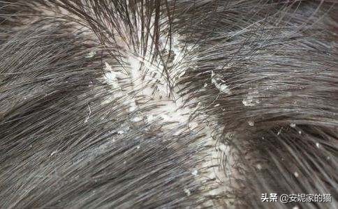 头屑多痒什么洗发水比较好,最有效的去油去头屑的洗发水