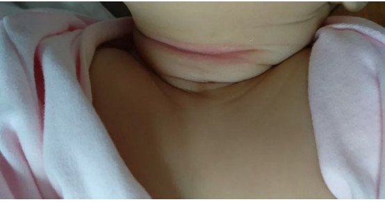 宝宝脖子上的痱子起脓包,痱子发红是快好了吗