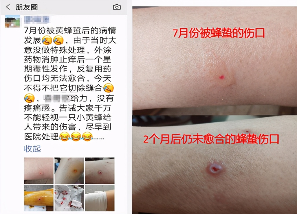 蜂蛰后如何处理,蜂蛰伤后该怎么处理