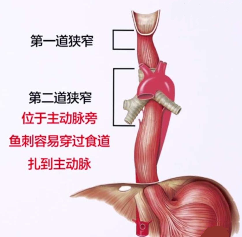 魏医生鱼刺卡喉急救方法,鱼刺卡喉现场急救