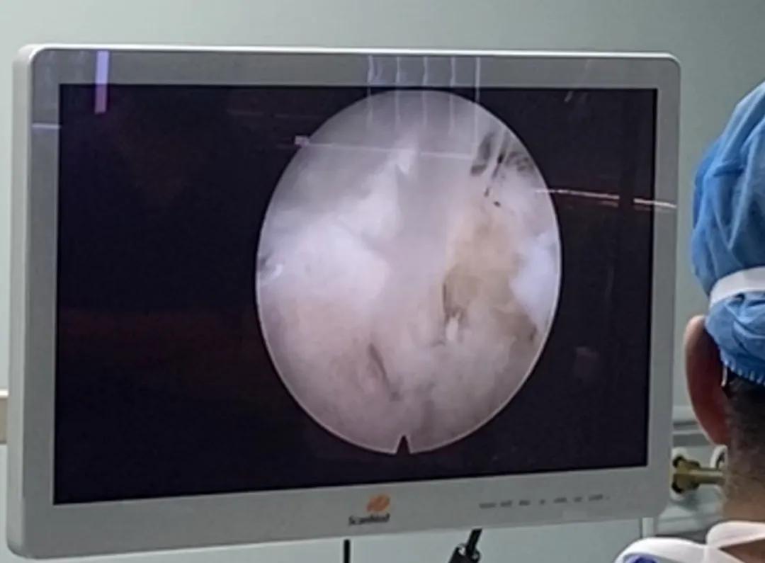 渭南治腰间盘突出哪家最好,脊柱神经外科手术