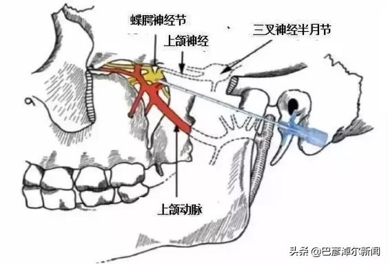 摆脱鼻炎困扰,过敏性鼻炎针刺哪些穴位有效