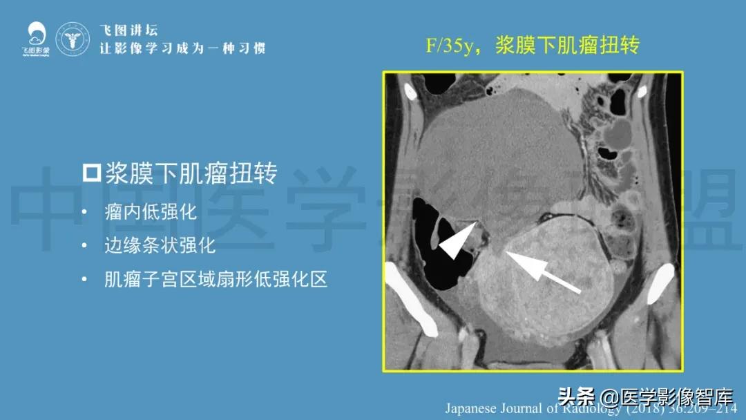 子宫解剖结构输卵管和卵巢位置,子宫附件ct影像学正常解剖表现