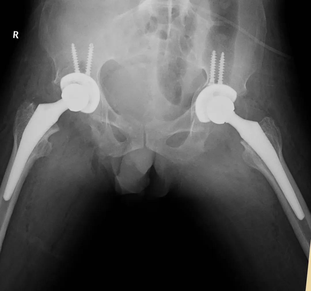 30岁强直性脊柱炎中医治愈案例,王永福院士治疗强直性脊柱炎案例