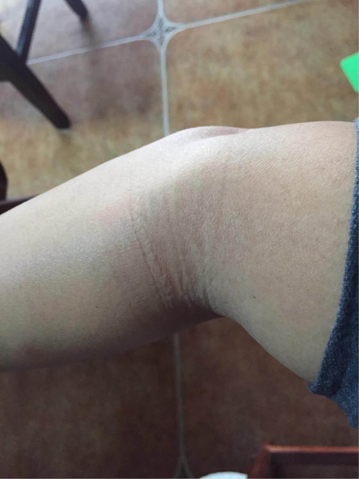 肱骨上髁炎推拿有用吗,简述肱骨外上髁炎的推拿治疗方案