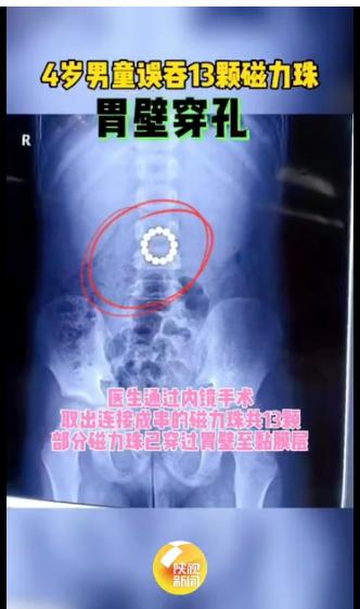 男童误吞123颗磁力珠,三岁男童误吞八颗磁力珠