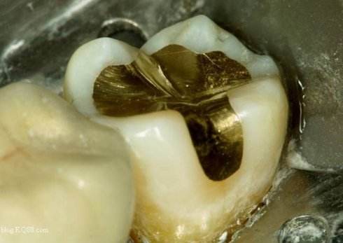 北京精德口腔,北京口腔医院补牙用的什么树脂