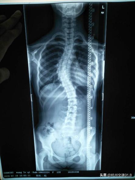 孩子为何斜着身子走路?原来是脊柱有问题