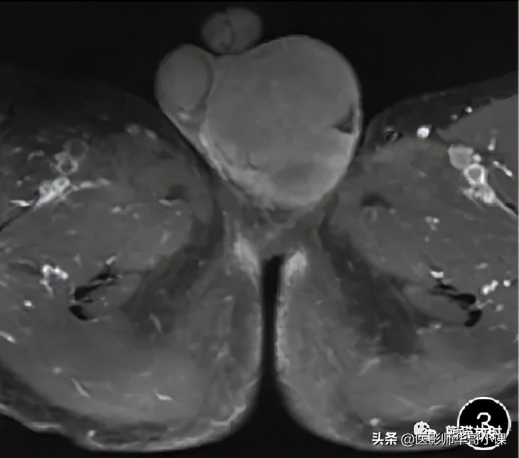 [精品课件]畸胎瘤及精原细胞瘤（*丸睾**肿瘤及肿瘤样变CT及MR表现）