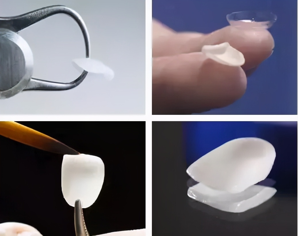 牙齿贴面能修复牙缝大的问题吗,齿科全瓷贴面美白