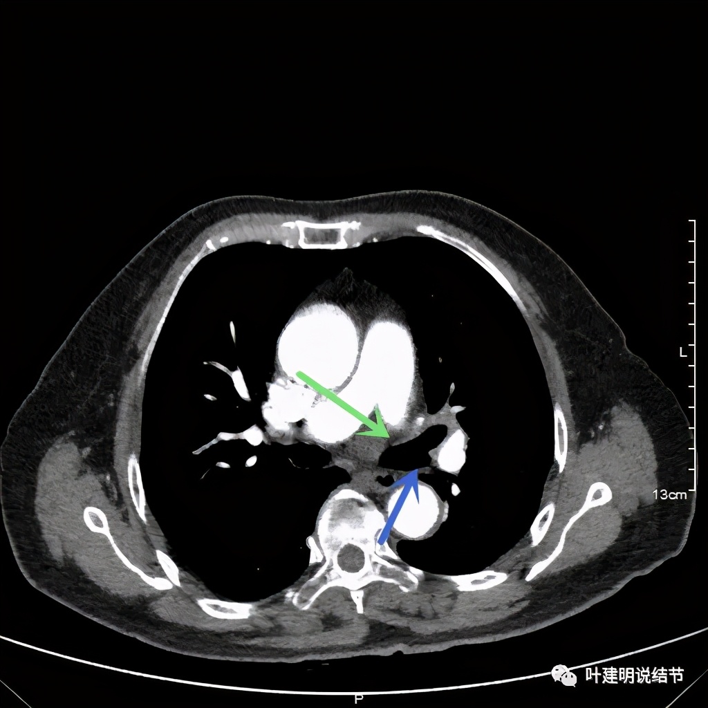 卡瑞利珠单抗治疗肺鳞癌有用吗,特瑞普利单抗对鳞癌治疗有效吗