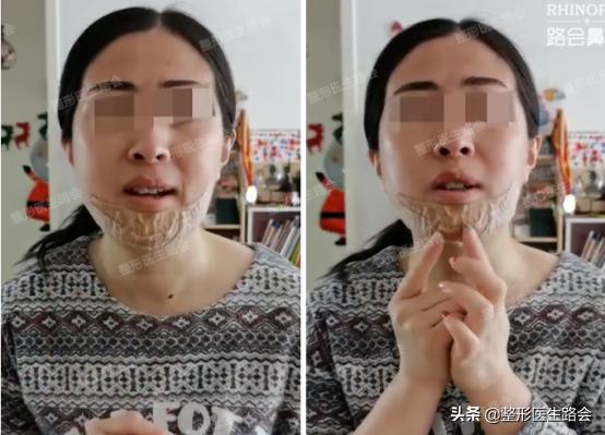 垫下巴手术流程,垫下巴手术的全过程