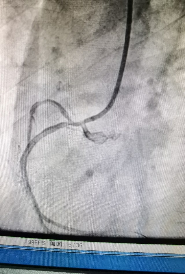 信阳市中心医院心脏射频消融手术,信阳中心医院心血管科室怎样