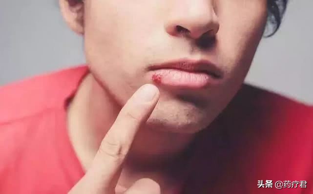 口角炎用维生素b2涂在嘴角,口角炎上火吃什么药