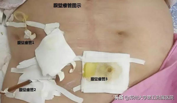 十来年肠绞痛的表现和处理方法,十年腹痛