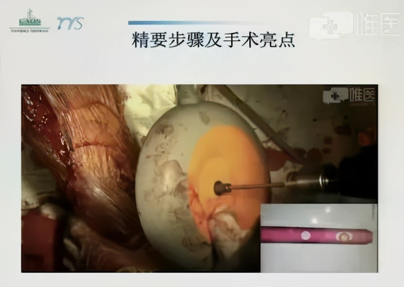 单纯的腓骨轻微骨折怎么治疗,70岁的人胫腓骨骨折了怎么治疗好