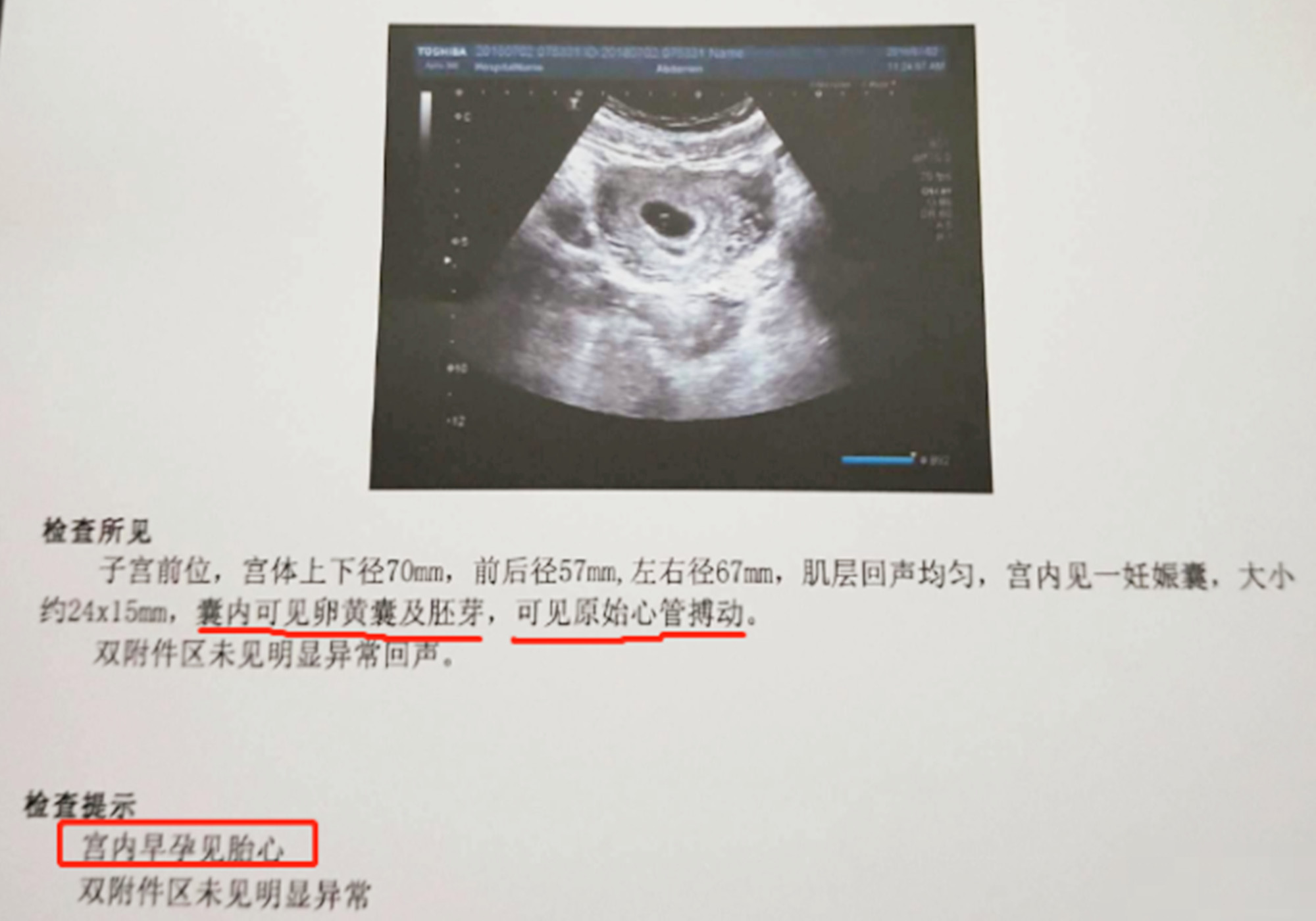 b超单怎么看孕囊在子宫位置,b超单如何看胎儿孕周