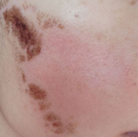 点阵激光能修复到什么程度,点阵激光凹陷疤痕能修复多少