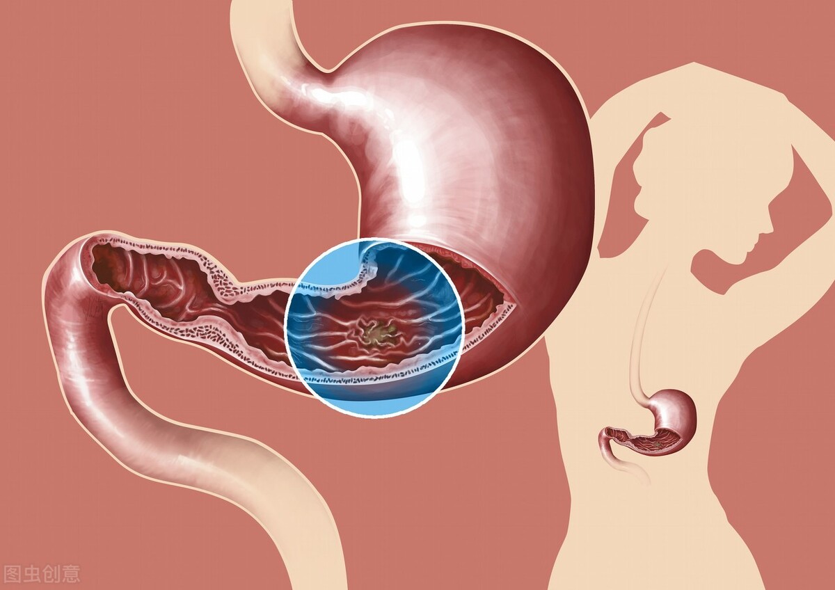 慢性糜烂萎缩性胃炎吃点什么好,萎缩性胃炎老感觉上火吃点什么药