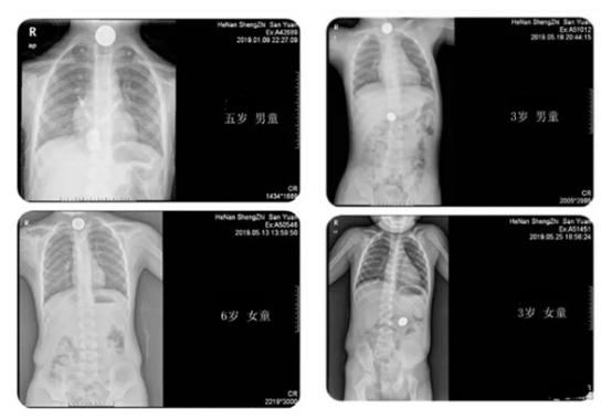 小孩吞了一个硬币,熊孩子吞掉硬币