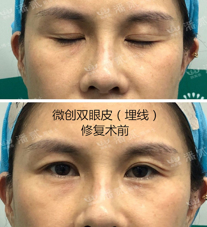 不割不埋线的双眼皮纳米技术,纳米无痕双眼皮和非手术区别