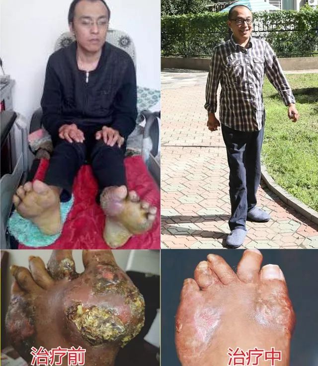 420高尿酸血症日中国第一家“痛风临床营养治疗基地”落户抗风竤