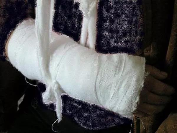 骨科医生提醒雪天摔倒易受伤部位,下雪天摔倒怎么及时处理