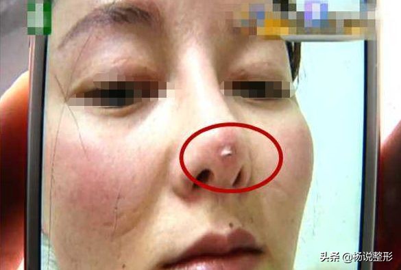 隆鼻失败的常见原因有哪些,隆鼻失败最快的解决方法