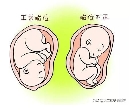 孕期胎位不正准妈妈莫慌张!