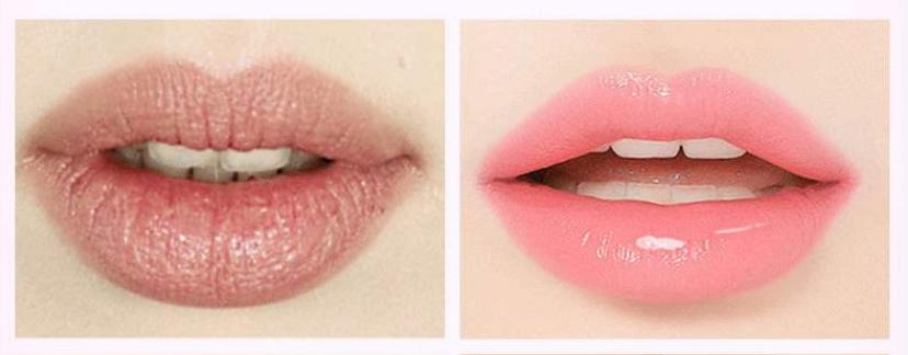 唇纹多怎么改善,唇纹怎么改善医美