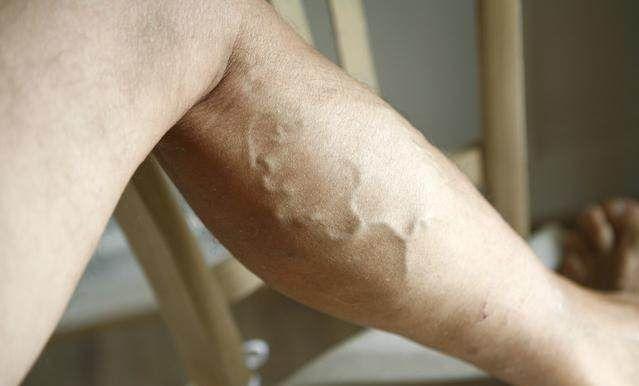 静脉曲张的危害什么是静脉曲张,预防静脉曲张穿多久静脉曲张袜