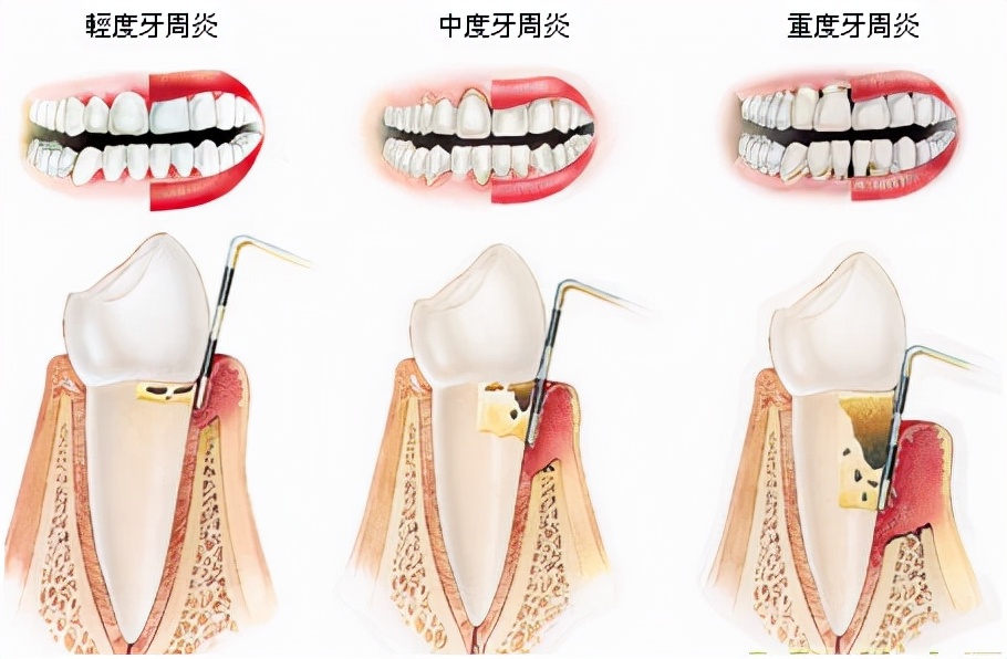 牙周病的预防措施不包括,牙周治疗不要半途而废