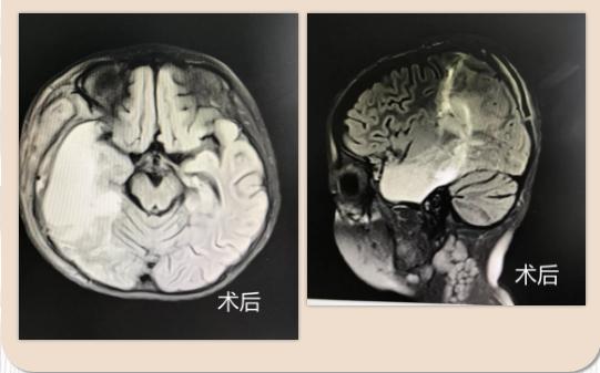 孩子癫痫发作后头痛是怎么回事,家长如何及早发现癫痫儿童的症状