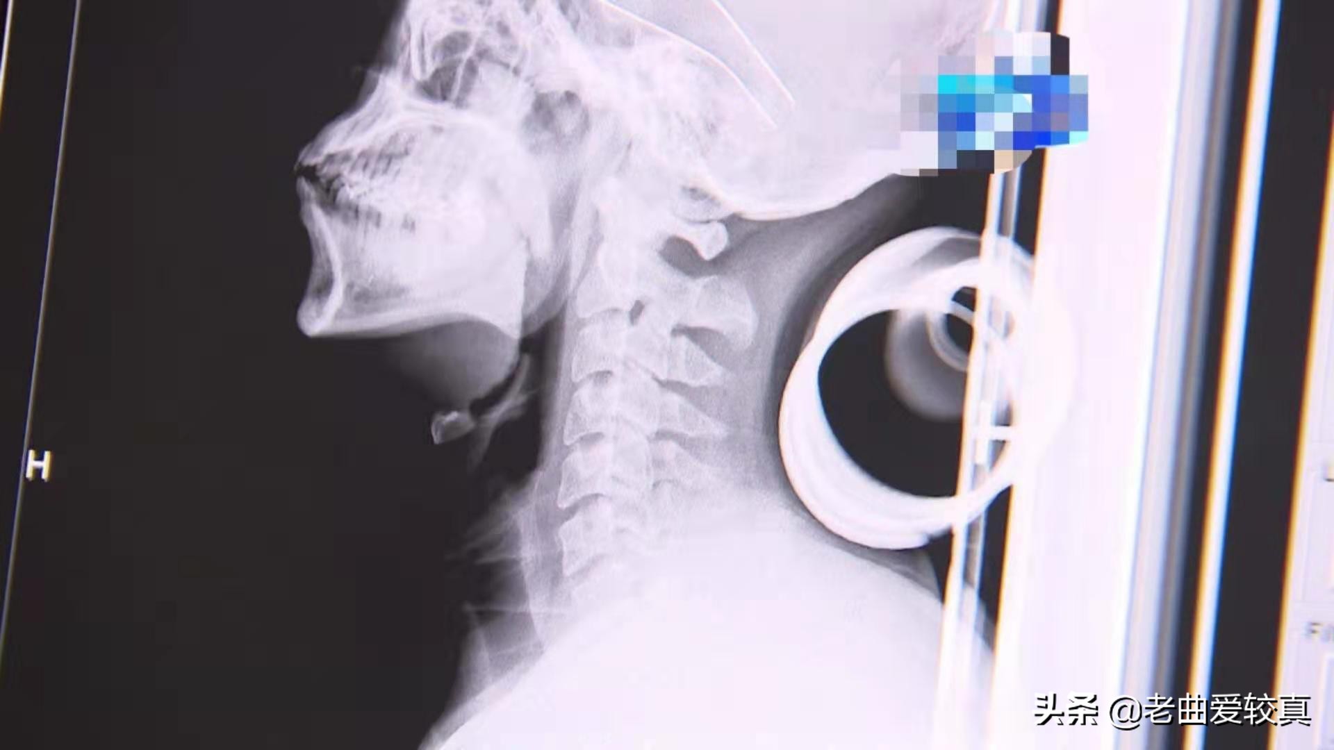 枕瓶子真的能治好颈椎病吗,酒瓶子当枕头可以治疗颈椎病吗