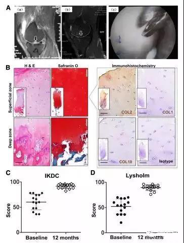 干细胞治疗膝关节疼痛案例,膝关节注射干细胞后疼痛持续多久