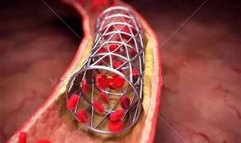 冠心病支架科普文,心内科冠脉支架