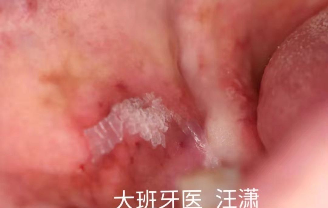 嘴里有一块白色斑块图片,嘴里长了白色凸出斑块怎么办