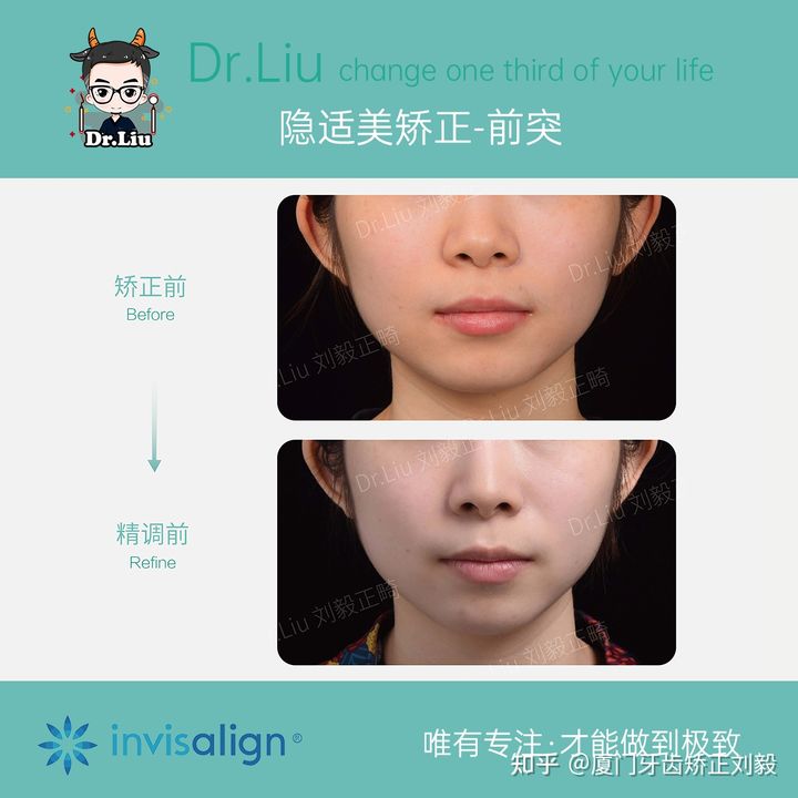 拔牙正畸矫正全过程3d,拔牙嘴凸正畸的真实案例