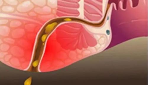 得了肛瘘不治疗会怎么样,肛瘘体验