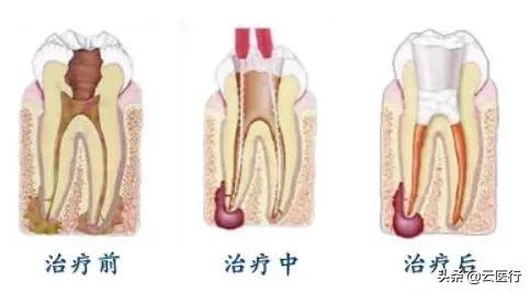 根管治疗后戴牙冠要磨两边的牙,牙齿根管治疗后必须戴牙冠吗