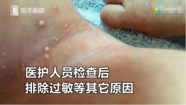 新生儿出生一身疙瘩,新生儿出生身上红疙瘩上面带白点