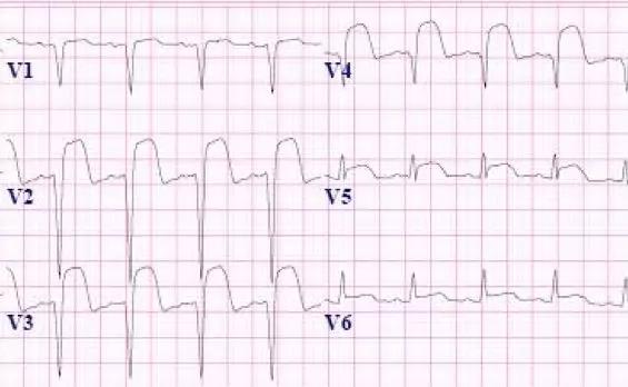 常见心梗特殊心电图,各部位心梗心电图详解